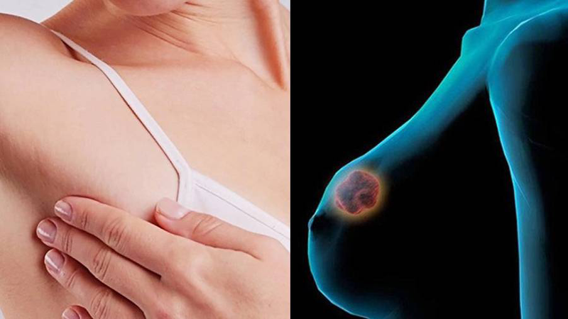 Người bệnh có thể sờ thấy hạch sưng to hoặc cứng dưới cánh tay