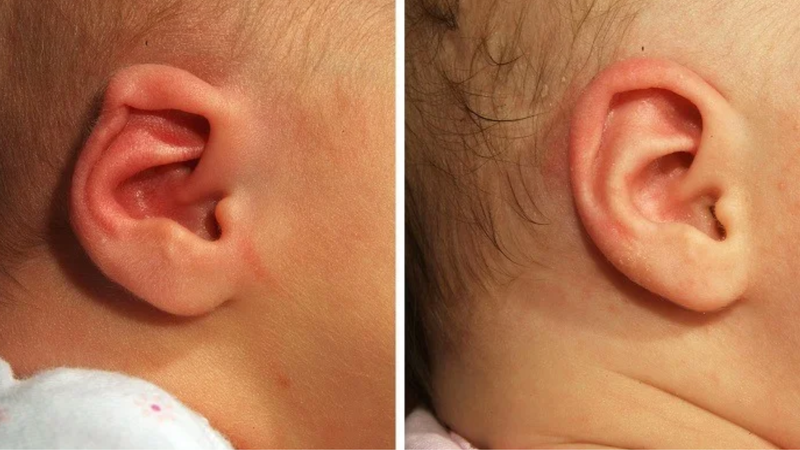 Những điều bạn cần biết về tai nhỏ - dị tật vành tai bẩm sinh 1