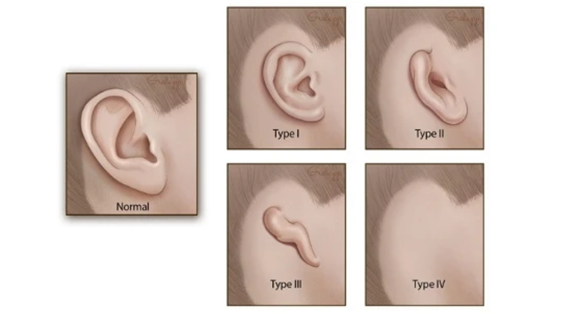 Những điều bạn cần biết về tai nhỏ - dị tật vành tai bẩm sinh 2