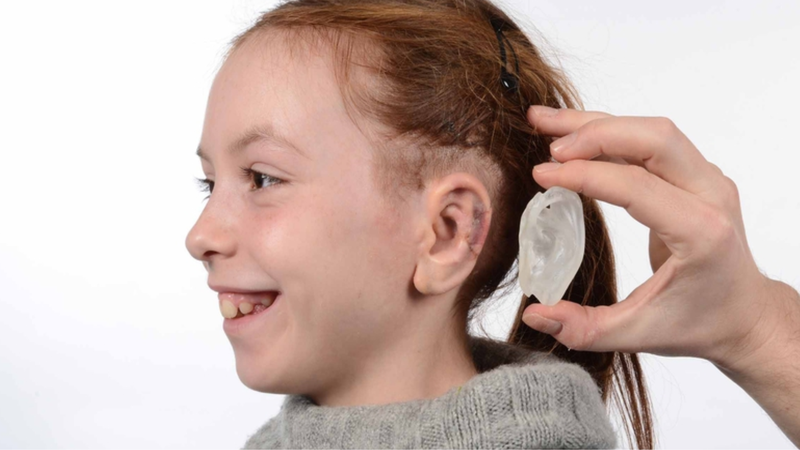 Những điều bạn cần biết về tai nhỏ - dị tật vành tai bẩm sinh 3