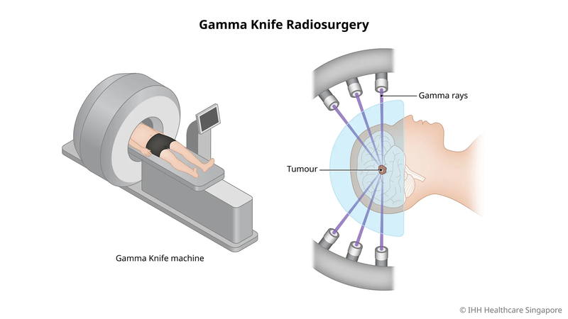 Những điều bạn cần biết về xạ phẫu gamma knife 2