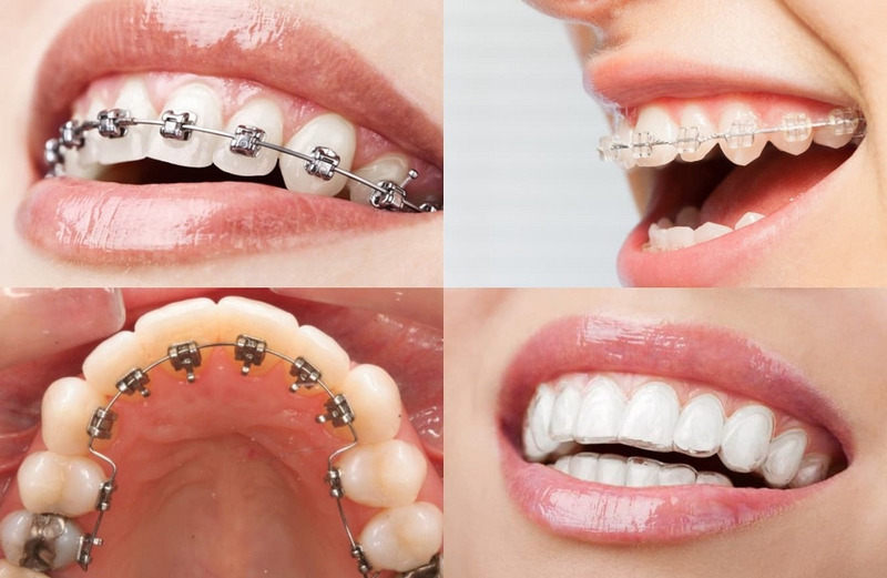 Những điều cần biết trước khi niềng răng mắc cài kim loại mặt trong 1