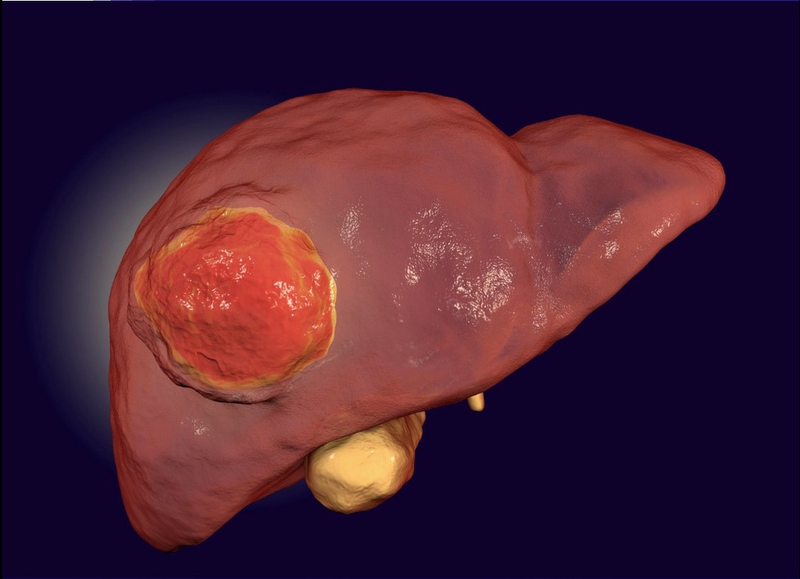 Những điều cần biết về các giai đoạn ung thư gan và các phương pháp điều trị 1