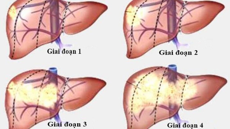 Những điều cần biết về các giai đoạn ung thư gan và các phương pháp điều trị 3