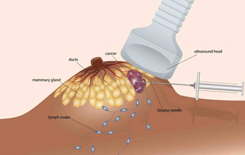 Những điều cần biết về khối u ung thư vú: Biểu hiện, chẩn đoán và hướng điều trị 3