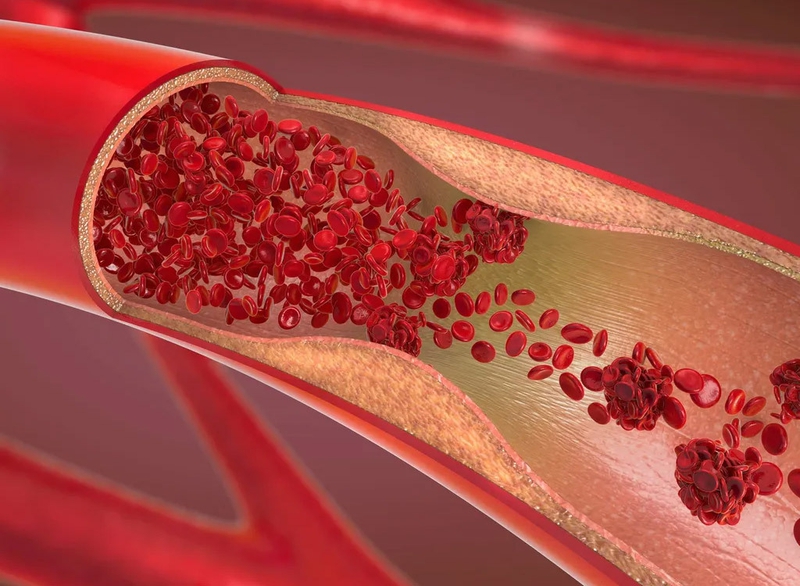 Những điều cần biết về mạch máu và các bệnh lý mạch máu thường gặp 2