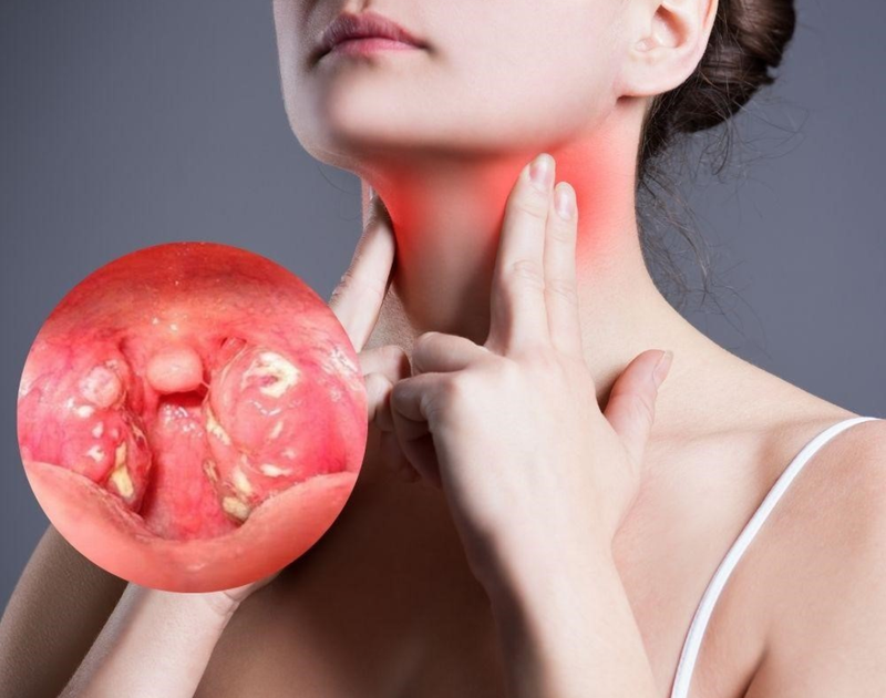 Những điều cần biết về viêm mũi họng
