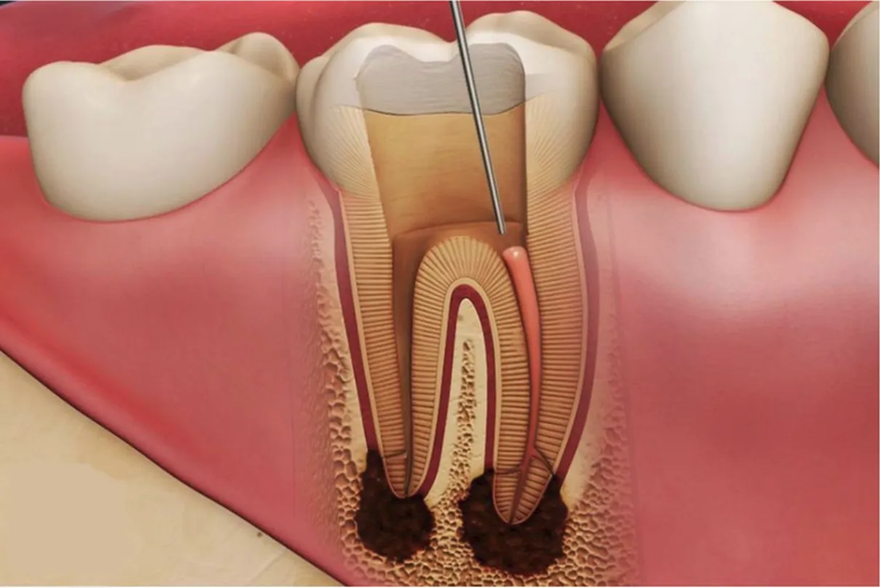 Những lưu ý khi chữa tủy răng số 6-2