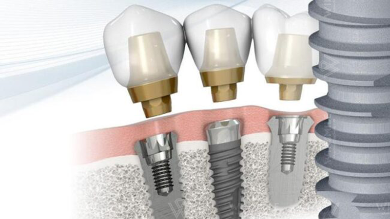 Những ưu điểm của trụ Implant DIO 2