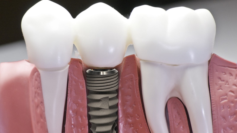 Những ưu điểm của trụ Implant DIO 3