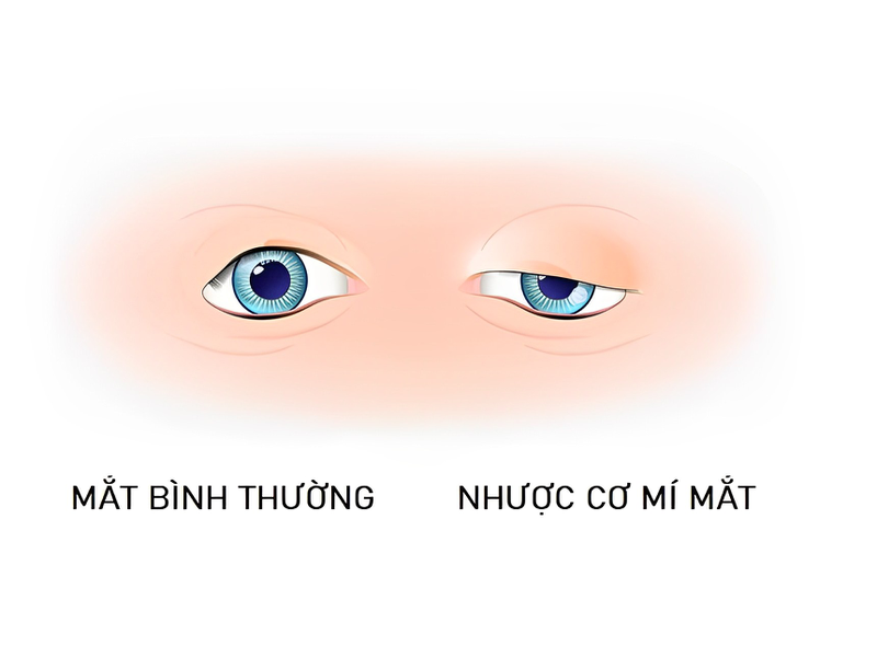 Triệu chứng và dấu hiệu nhận biết bệnh nhược cơ sụp mi mắt