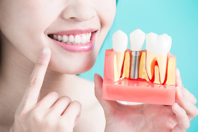 Nhược điểm của trồng răng implant có thể bạn chưa biết 2