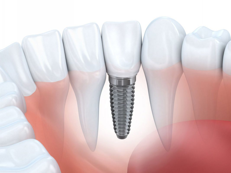 Nhược điểm của trồng răng implant có thể bạn chưa biết 4
