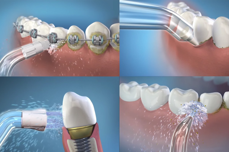Nhược điểm của trồng răng implant có thể bạn chưa biết 5