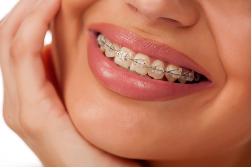 Niềng răng 1 hàm mất bao lâu? 5 yếu tố ảnh hưởng trực tiếp 1