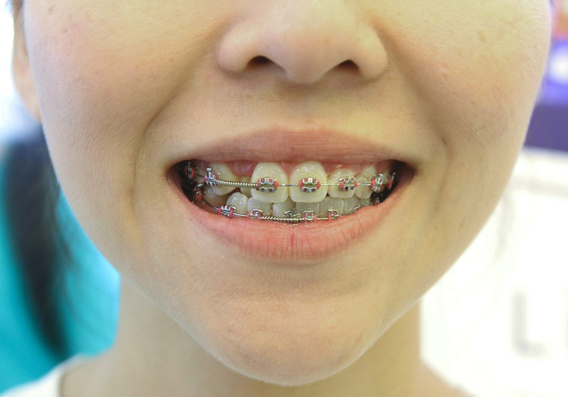Niềng răng bị lệch mặt: Nguyên nhân, cách khắc phục và cách phòng ngừa 1