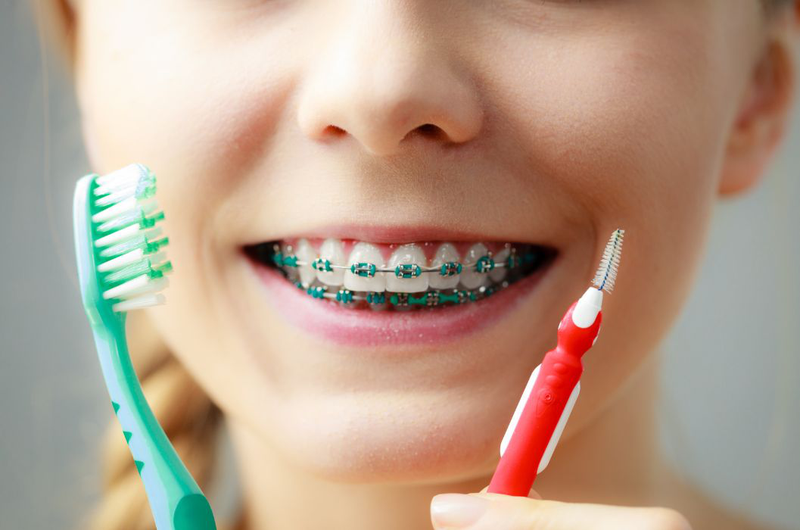 Niềng răng bị nhiệt miệng: Nguyên nhân, cách điều trị và phòng ngừa 4