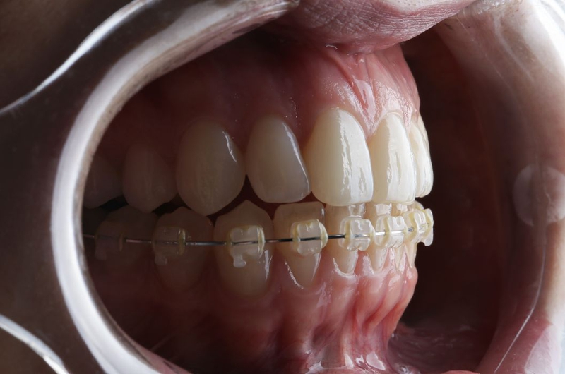 Chỉ niềng răng hàm dưới được không? Giải đáp từ nha sĩ 2