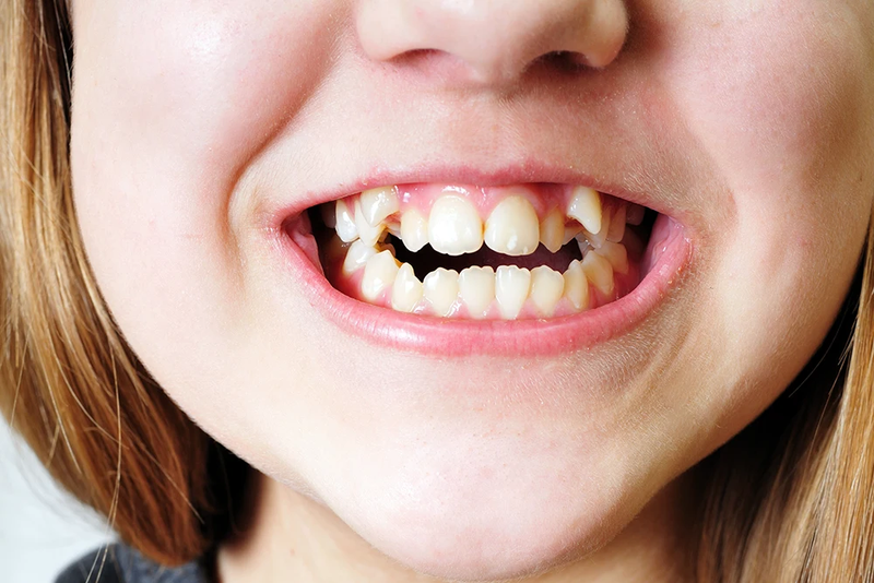 Niềng răng lệch lạc: 5 loại mắc cài thường được sử dụng 1