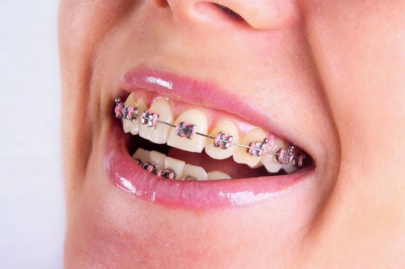Niềng răng lệch lạc: 5 loại mắc cài thường được sử dụng 3