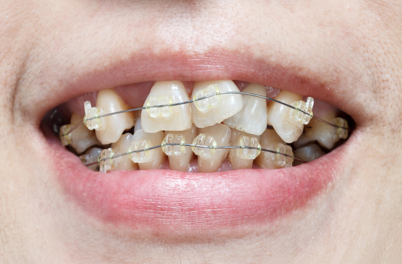 Niềng răng lệch lạc: 5 loại mắc cài thường được sử dụng 4