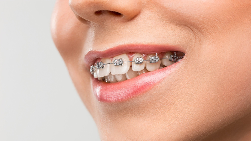 Niềng răng đem lại nụ cười tự tin hơn