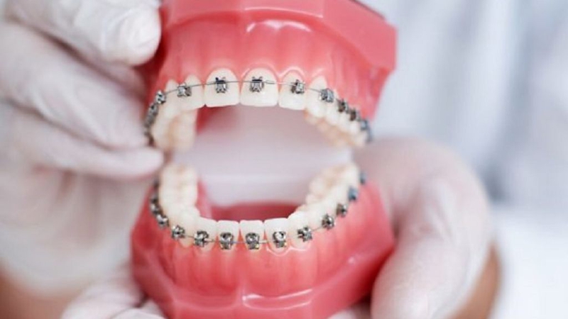 Niềng răng mắc cài sứ dây trong: Đặc điểm, tác dụng 1