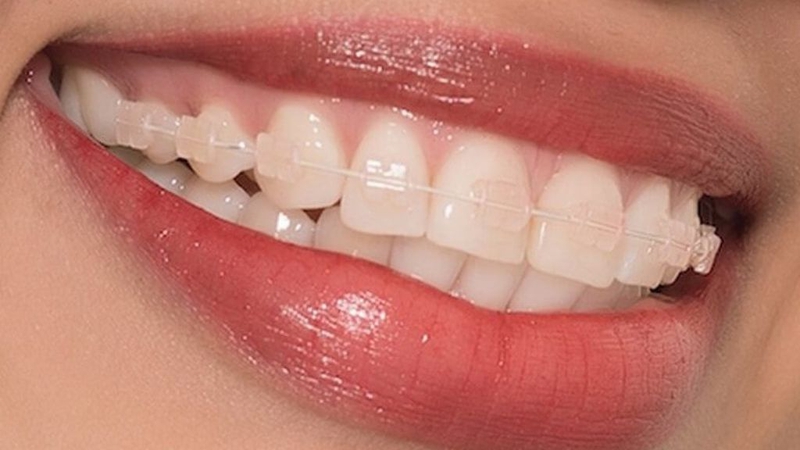 Niềng răng mắc cài sứ dây trong: Đặc điểm, tác dụng 2