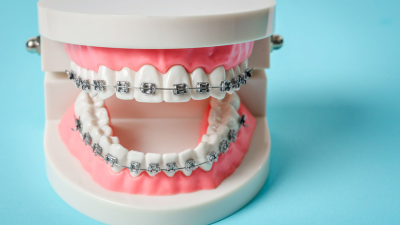Niềng răng mắc cài sứ và kim loại: So sánh để lựa chọn chính xác! 1