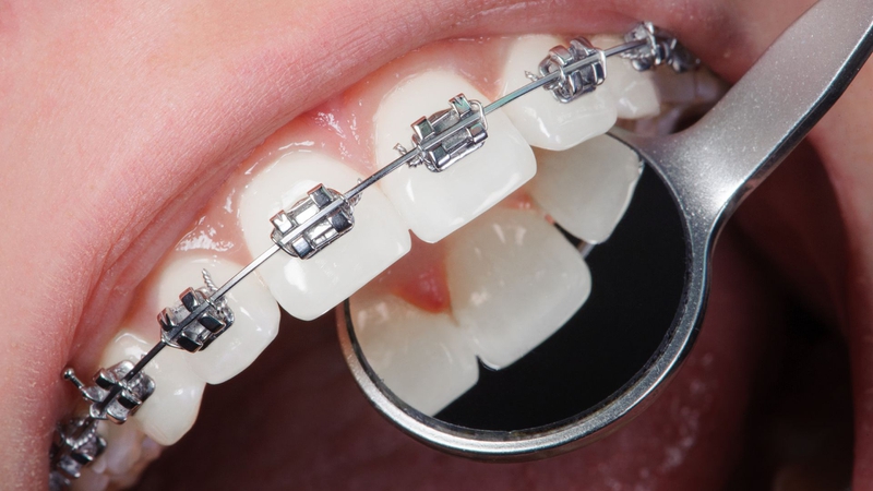 Niềng răng mắc cài sứ và kim loại: So sánh để lựa chọn chính xác! 3