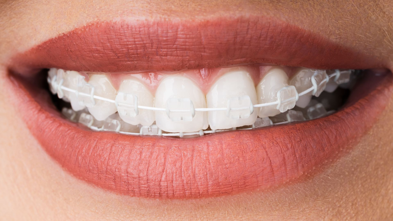 Niềng răng mắc cài sứ và kim loại: So sánh để lựa chọn chính xác! 4
