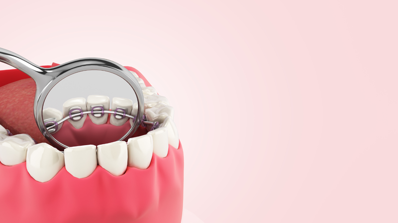 Niềng răng mặt trong (mặt lưỡi) là gì? Ưu nhược điểm và chi phí 4
