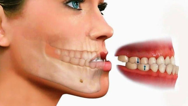 Niềng răng móm có phải nhổ răng không? Chăm sóc thế nào? 1