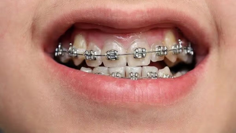 Niềng răng móm có phải nhổ răng không? Chăm sóc thế nào? 2