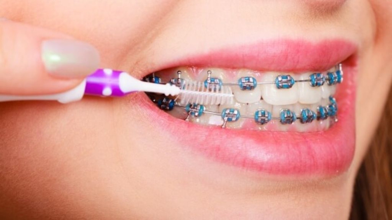 Niềng răng móm có phải nhổ răng không? Chăm sóc thế nào? 3