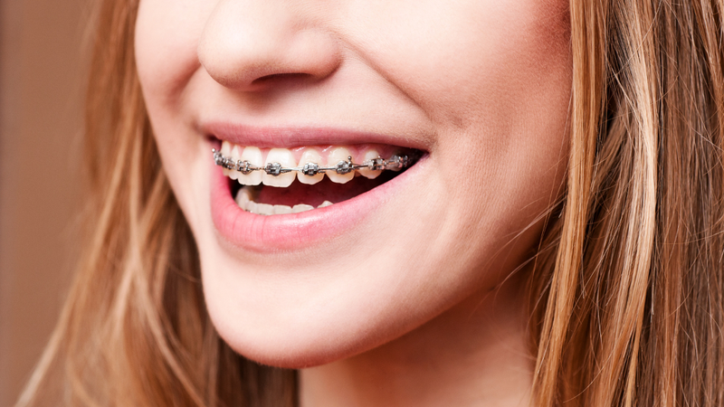 Niềng răng móm có ưu điểm gì? Những điều cần lưu ý trong quá trình niềng răng móm 3