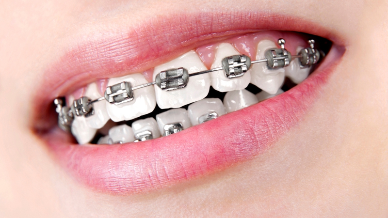 Niềng răng móm có ưu điểm gì? Những điều cần lưu ý trong quá trình niềng răng móm 6