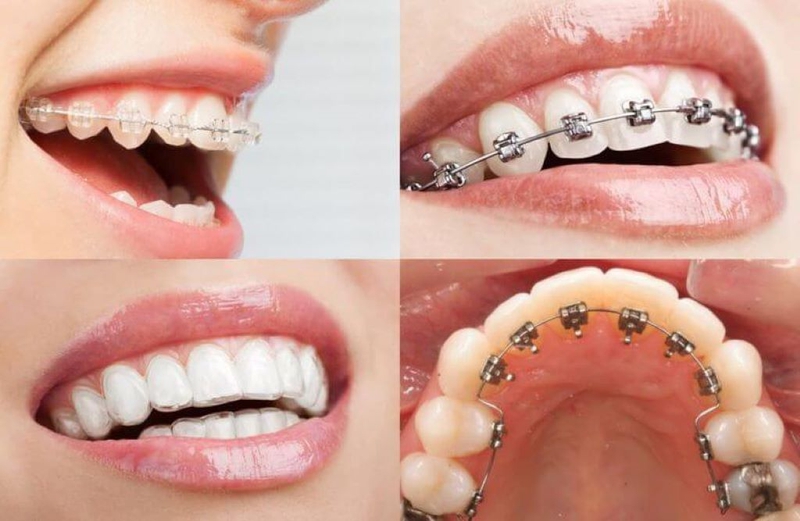 Niềng răng một hàm có được không? Những trường hợp có thể niềng răng một hàm? 1
