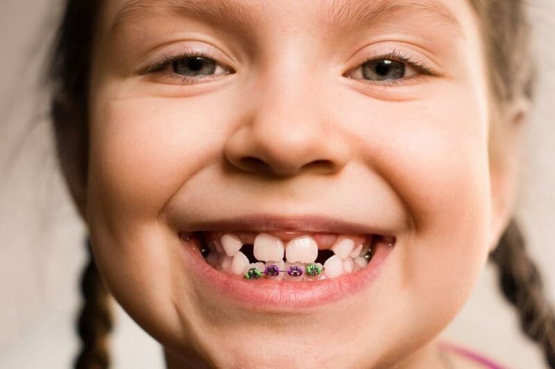 Niềng răng một hàm có được không? Những trường hợp có thể niềng răng một hàm? 2