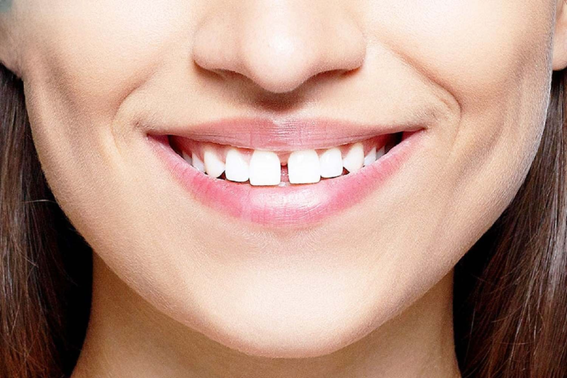 Niềng răng một hàm có được không? Những trường hợp có thể niềng răng một hàm? 3
