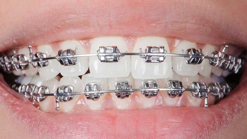 Niềng răng thất bại: Nguyên nhân và cách khắc phục 1
