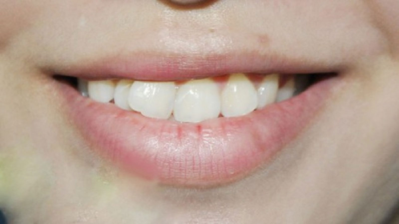 Niềng răng thất bại: Nguyên nhân và cách khắc phục 2