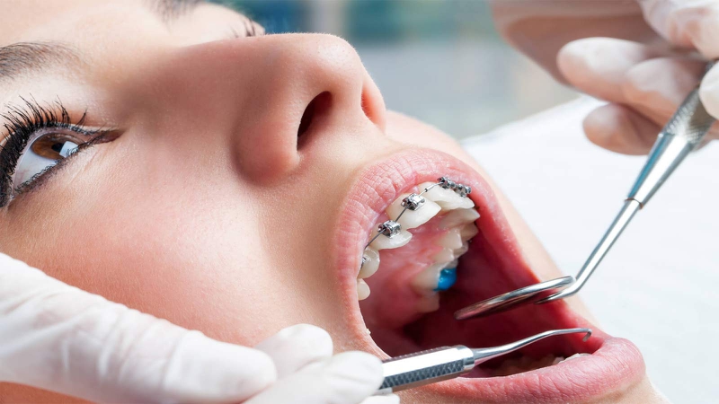 Niềng răng thất bại: Nguyên nhân và cách khắc phục 5