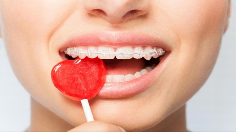Niềng răng thất bại: Nguyên nhân và cách khắc phục 4