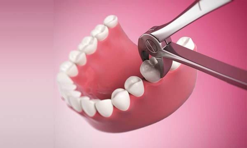 Niềng răng trong suốt có cần nhổ răng không? Lợi ích của Invisalign 3