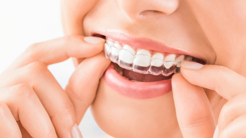 Niềng răng trong suốt mất bao lâu? Có thể rút ngắn không? 1