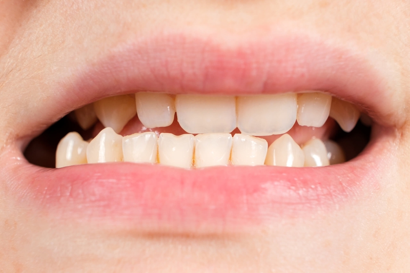 Niềng răng trong suốt mất bao lâu? Có thể rút ngắn không? 2