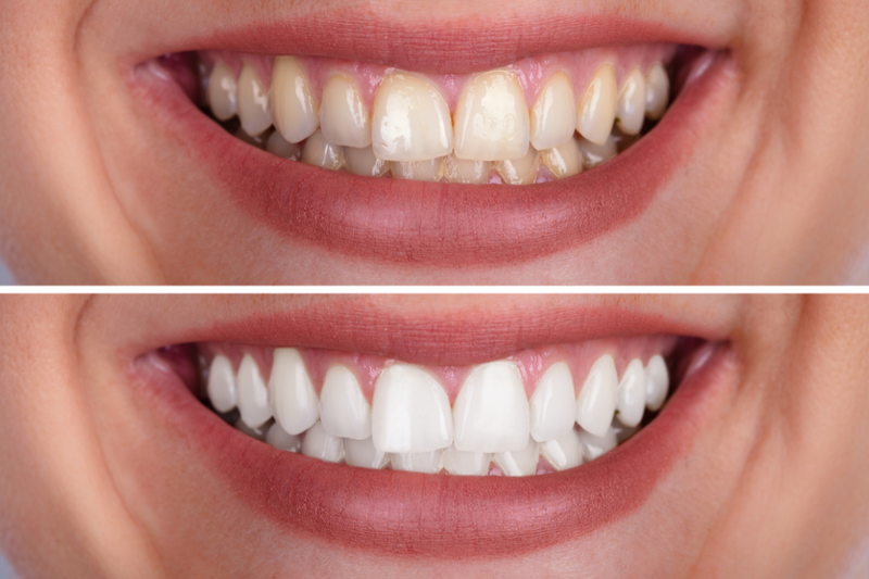 Niềng răng xong bị hô là tình trạng gì?  3