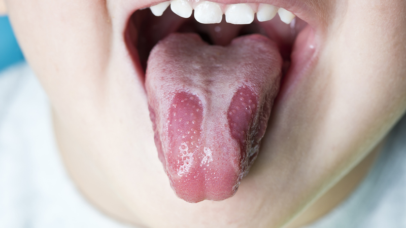 Nổi hạch dưới lưỡi có phải là dấu hiệu cảnh báo bệnh ung thư lưỡi không? 2