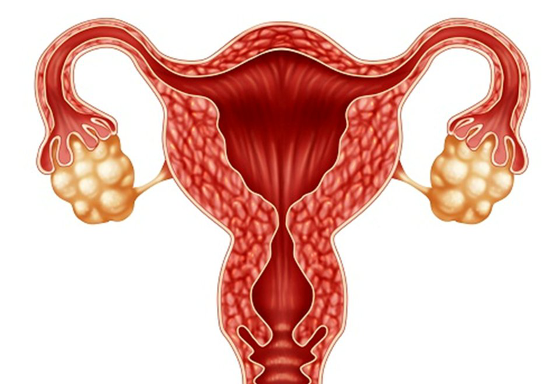 Nội mạc tử cung dày báo hiệu bệnh gì? 2